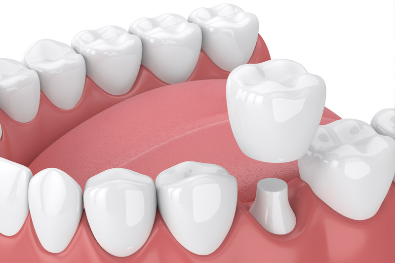 Dental Crowns in West Springfield