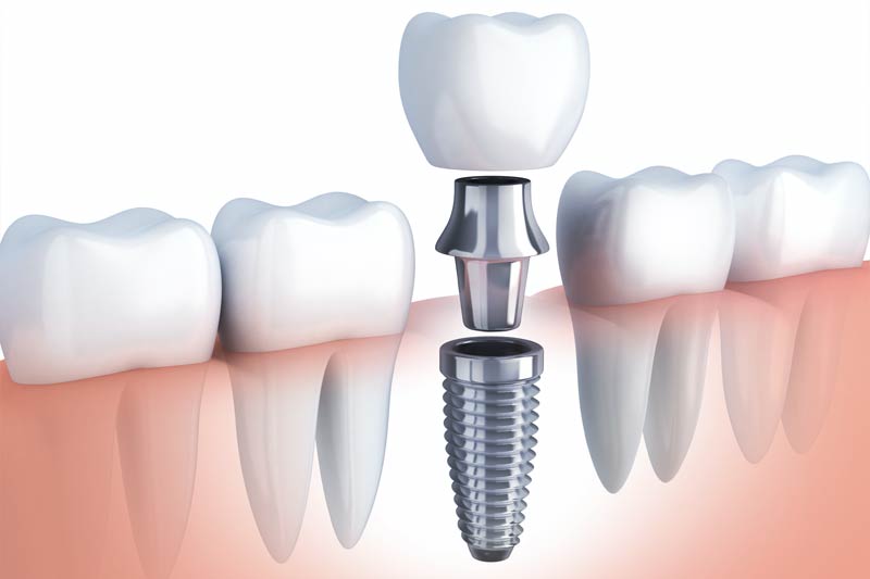 Implants Dentist in West Springfield
